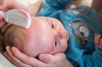 Как убрать молочные корочки на голове у ребенка - полное руководство