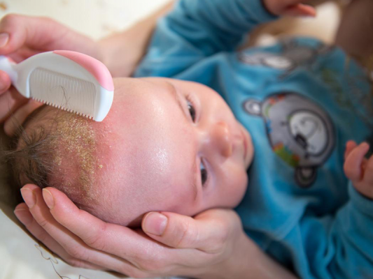 Как убрать молочные корочки на голове у ребенка - полное руководство