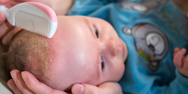 Как убрать молочные корочки на голове у ребенка - полное руководство