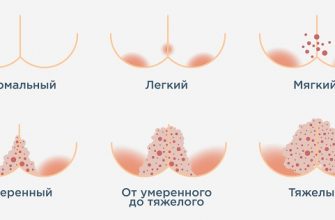 Как диагностировать по фото и чем лечить пеленочный дерматит у новорожденного?