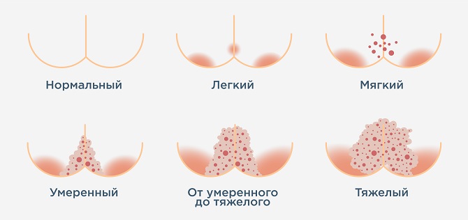 Как диагностировать по фото и чем лечить пеленочный дерматит у новорожденного?