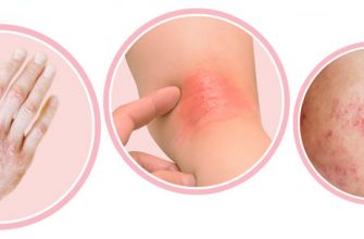 Красные или белые сухие пятна на теле ребёнка: дерматит или ксероз?