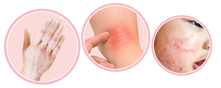 Красные или белые сухие пятна на теле ребёнка: дерматит или ксероз?