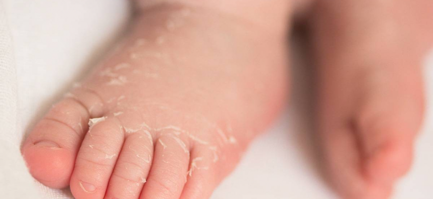 Почему облазит сухая кожа на пальцах ног у ребенка и чем лечить?