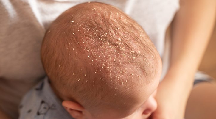 Чем лечить и как диагностировать себорейный дерматит у детей по фото?
