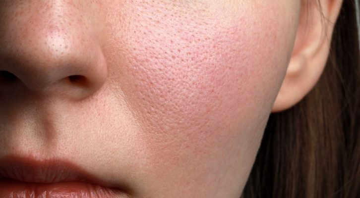 Как избавиться от ощущения стянутости кожи лица и тела в домашних условиях