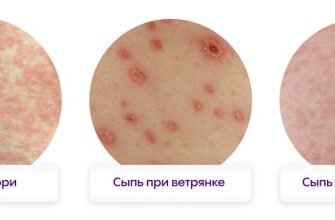 Топ-10 видов мелкой сыпи у ребенка с фото, причинами и симптомами