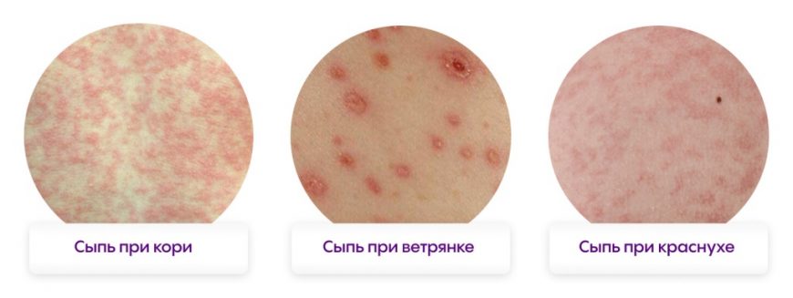 Топ-10 видов мелкой сыпи у ребенка с фото, причинами и симптомами