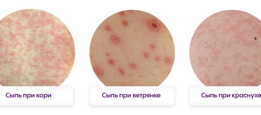 Топ-10 видов мелкой сыпи у ребенка с фото, причинами и симптомами